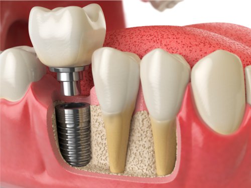 Modell-Darstellung von Implantaten beim Zahnarzt
